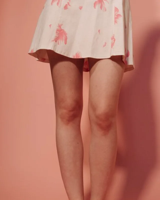 Natural image showing spider veins