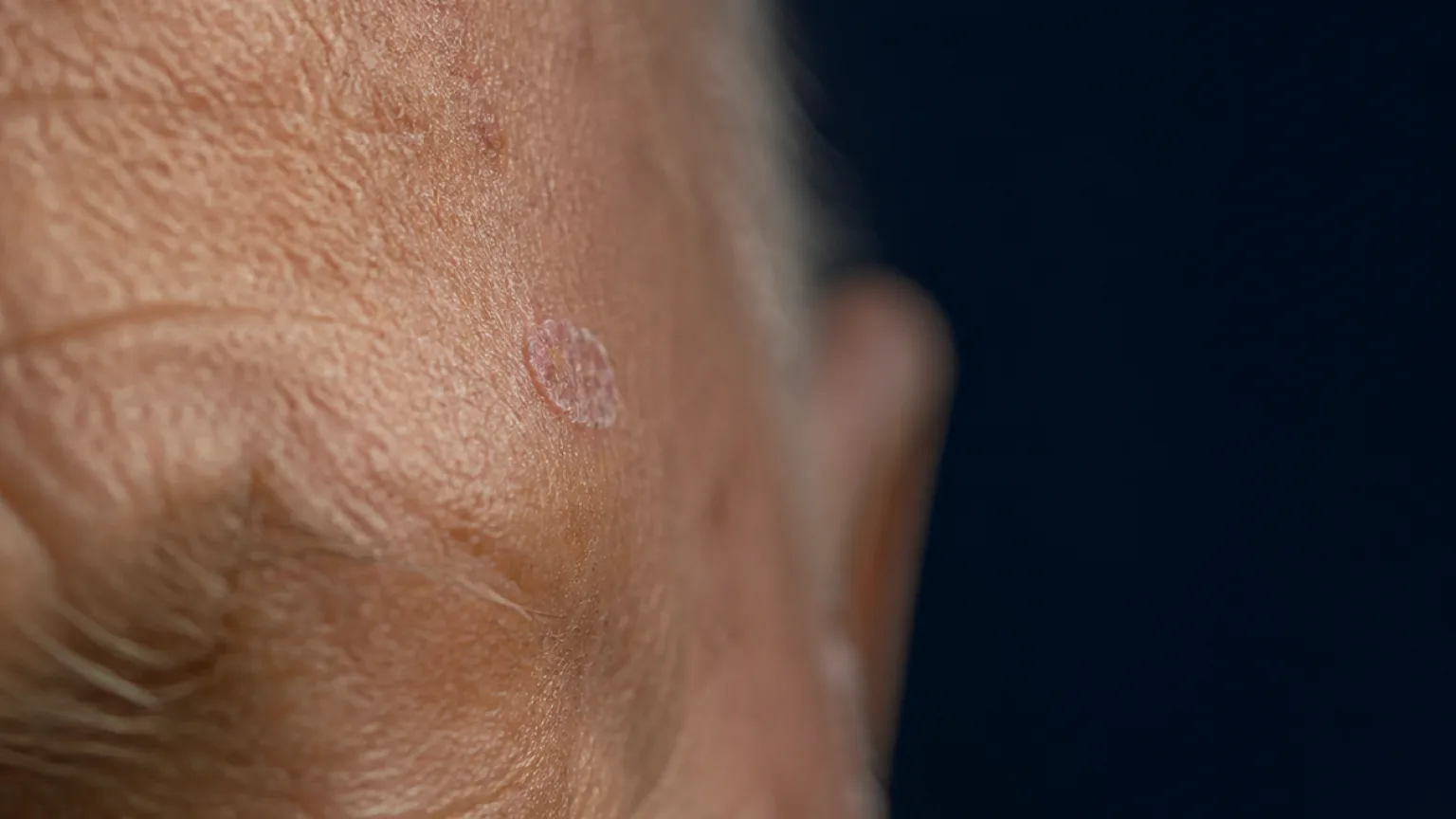Cinematic macro photograph of a small actinic keratosis patch on sun-exposed mature skin