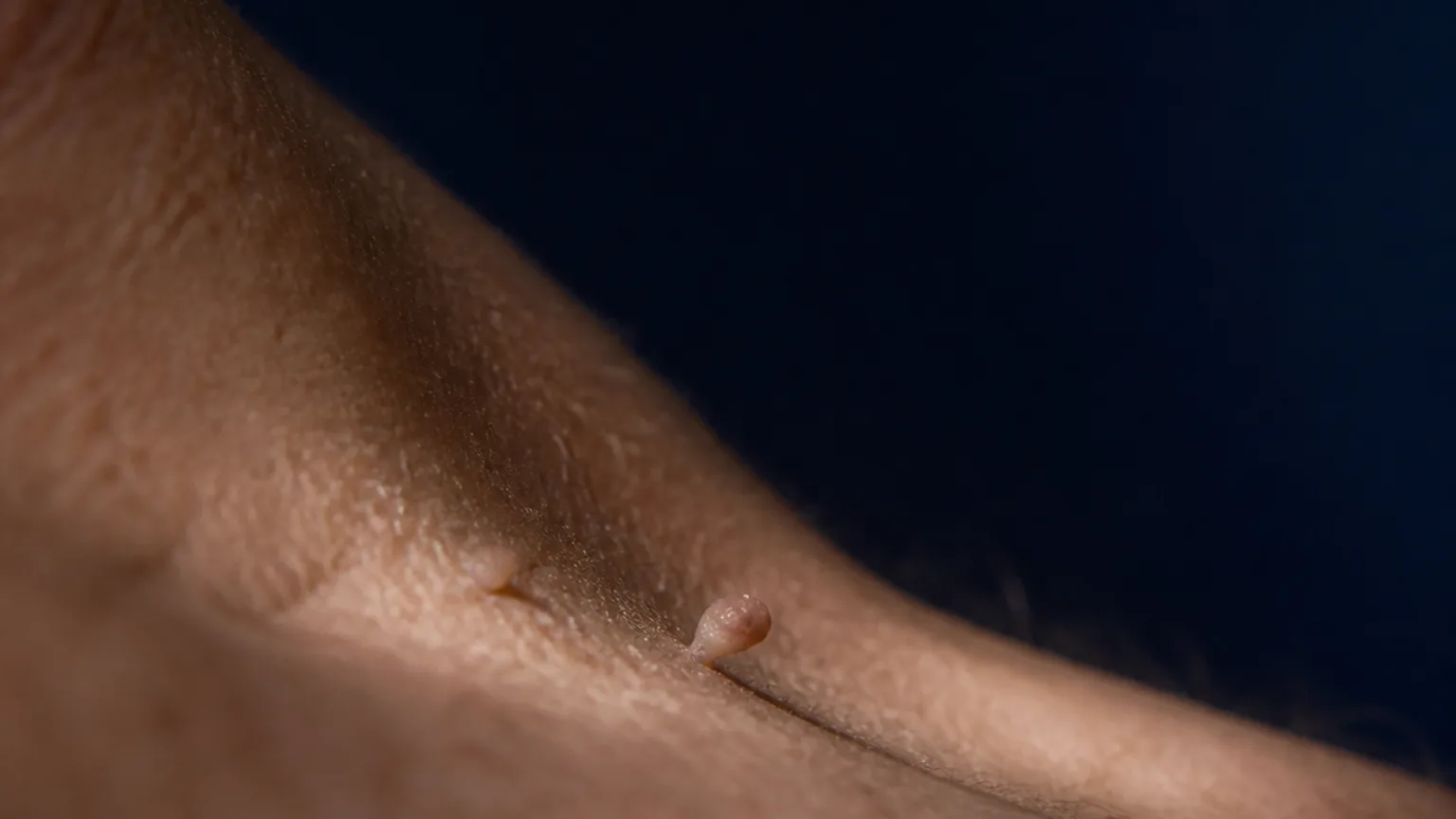 Close clinical view of small skin tags on natural skin