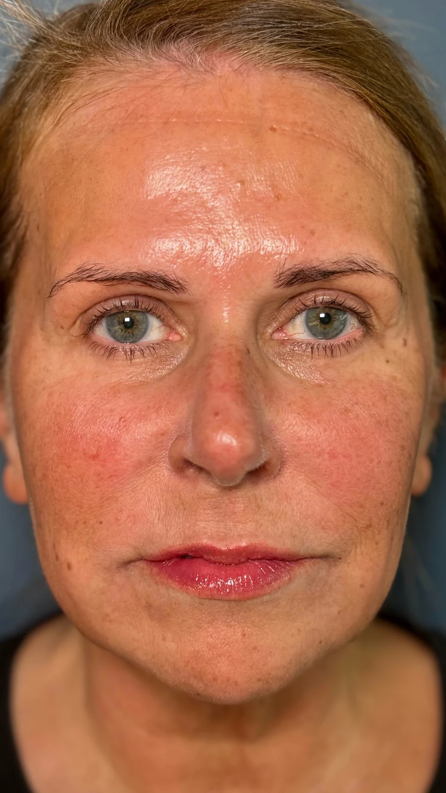 After dermal filler treatment: full-face harmonisation at Rejuvena, Bedford