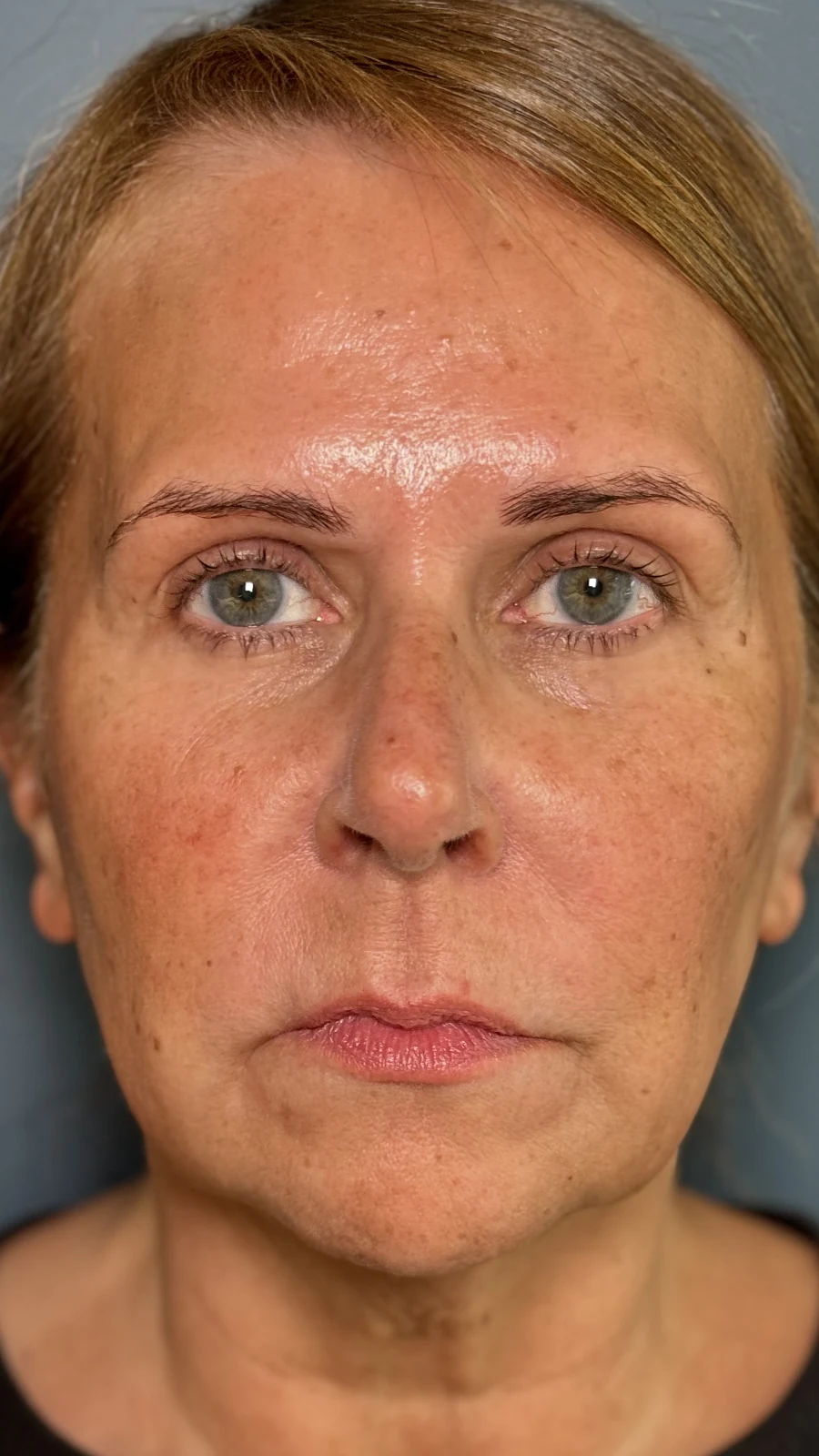 Before dermal filler treatment: full-face harmonisation at Rejuvena, Bedford
