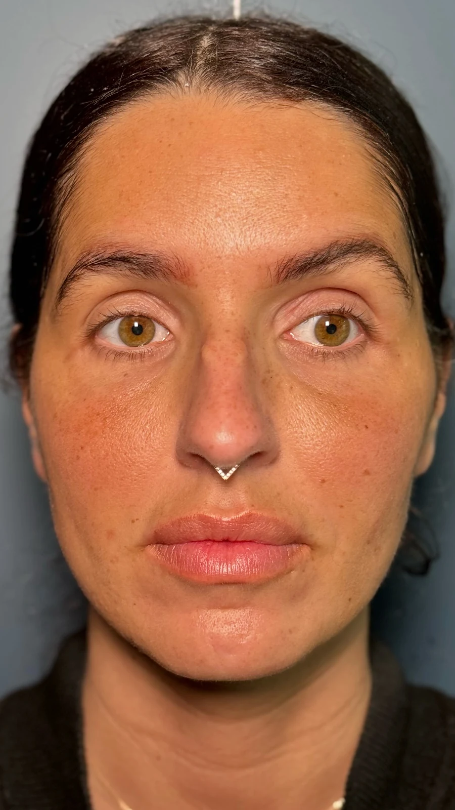 After dermal filler treatment: cheek & midface restoration at Rejuvena, Bedford