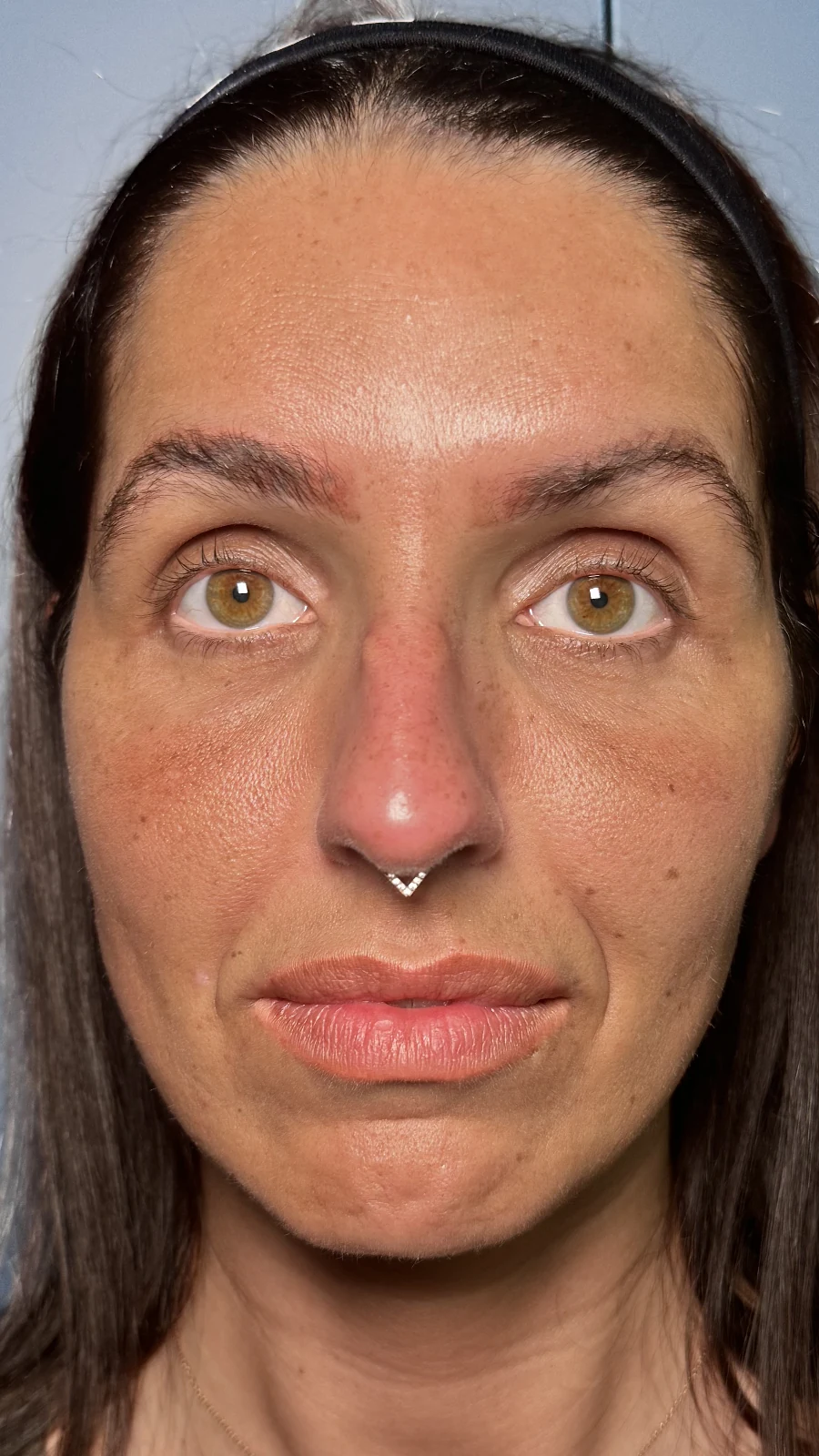 Before dermal filler treatment: cheek & midface restoration at Rejuvena, Bedford
