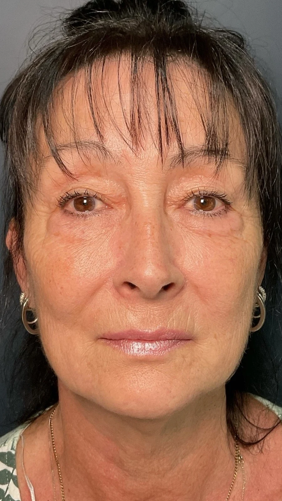 After dermal filler treatment: facial balancing at Rejuvena, Bedford