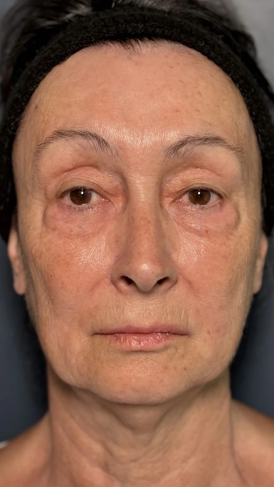 Before dermal filler treatment: facial balancing at Rejuvena, Bedford