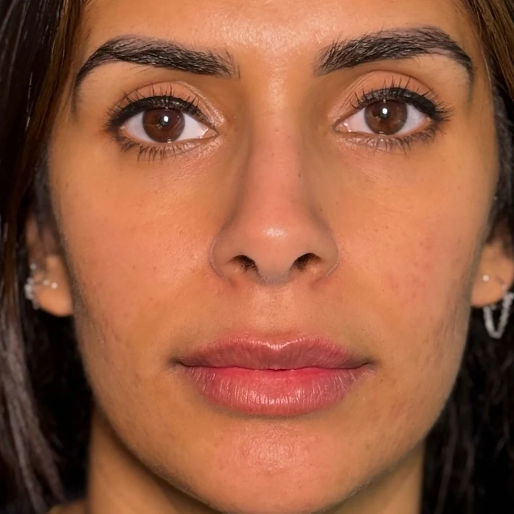 After lip filler: lip enhancement at Rejuvena Clinic, Bedford