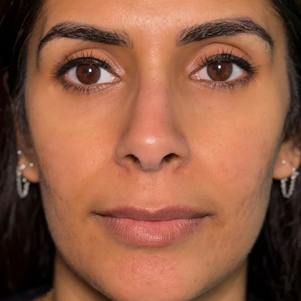 Before lip filler: lip enhancement at Rejuvena Clinic, Bedford