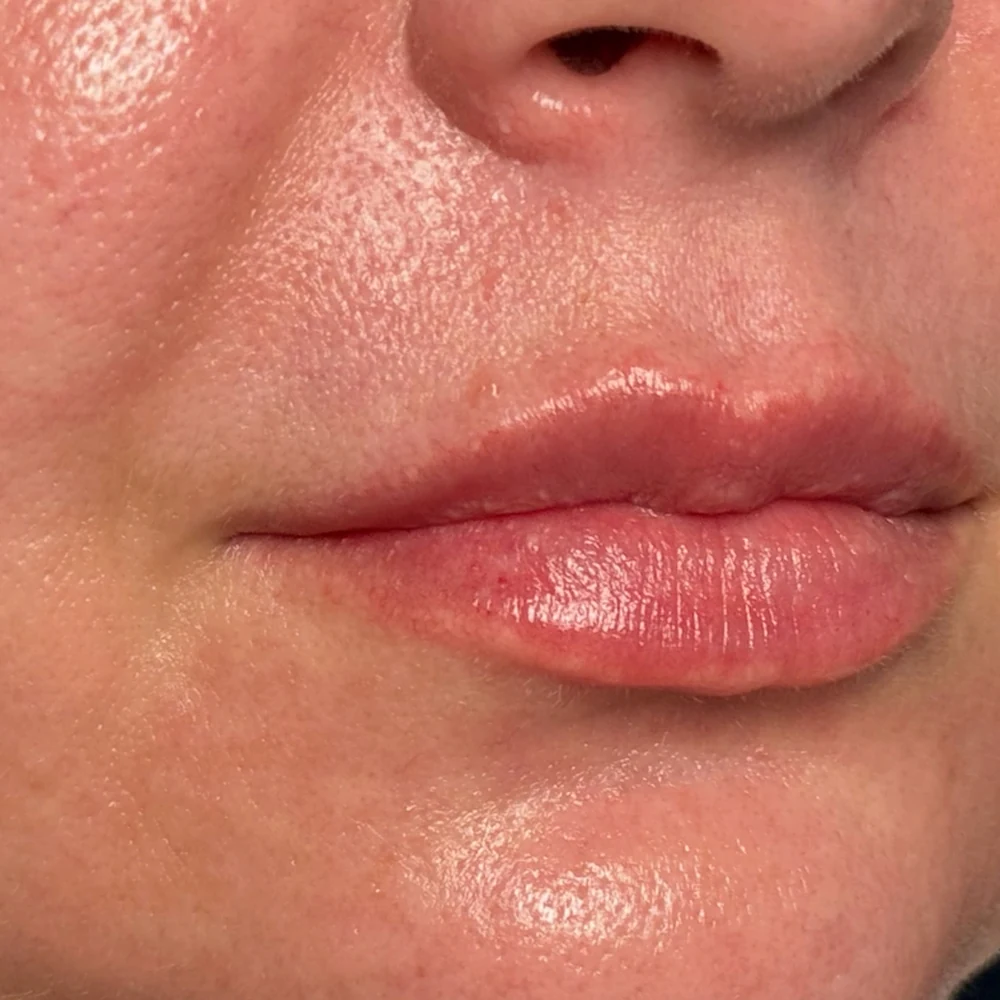 After lip filler: lip definition at Rejuvena Clinic, Bedford