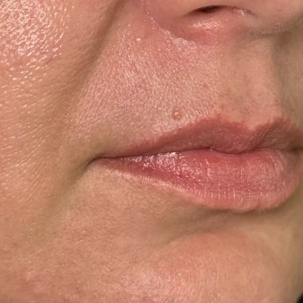 Before lip filler: lip definition at Rejuvena Clinic, Bedford