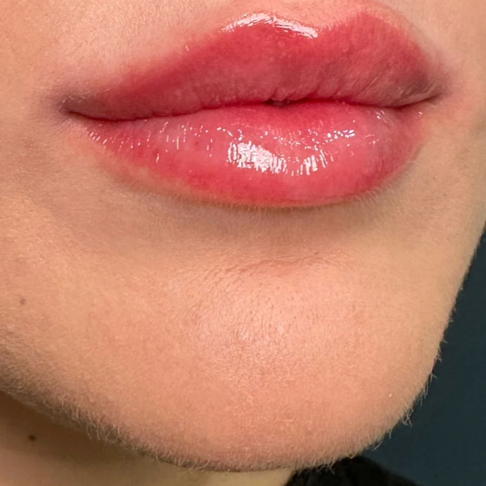 After lip filler: natural lip filler at Rejuvena Clinic, Bedford