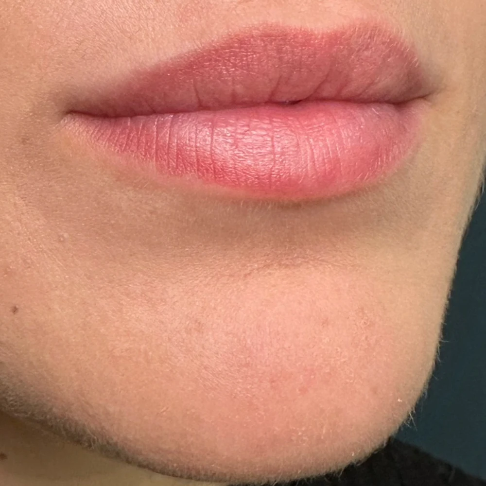 Before lip filler: natural lip filler at Rejuvena Clinic, Bedford