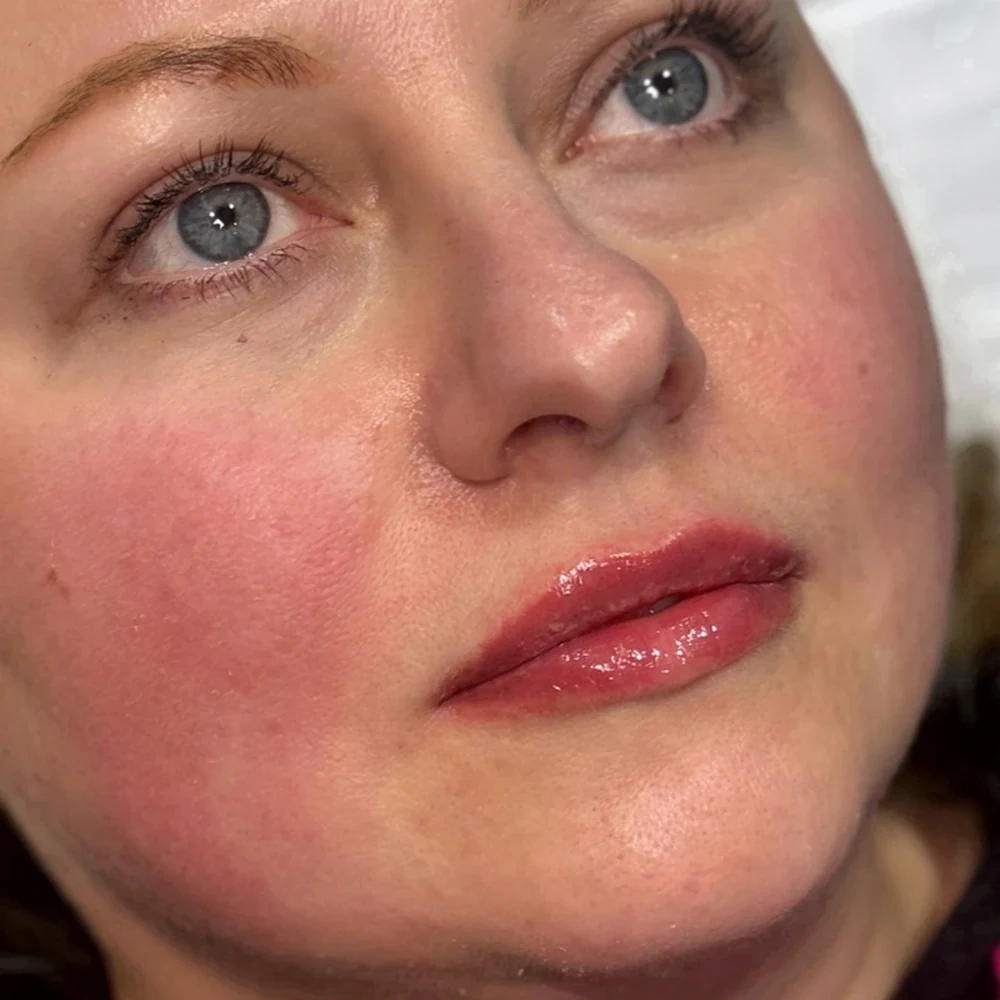 After lip filler: lip volume and balance at Rejuvena Clinic, Bedford
