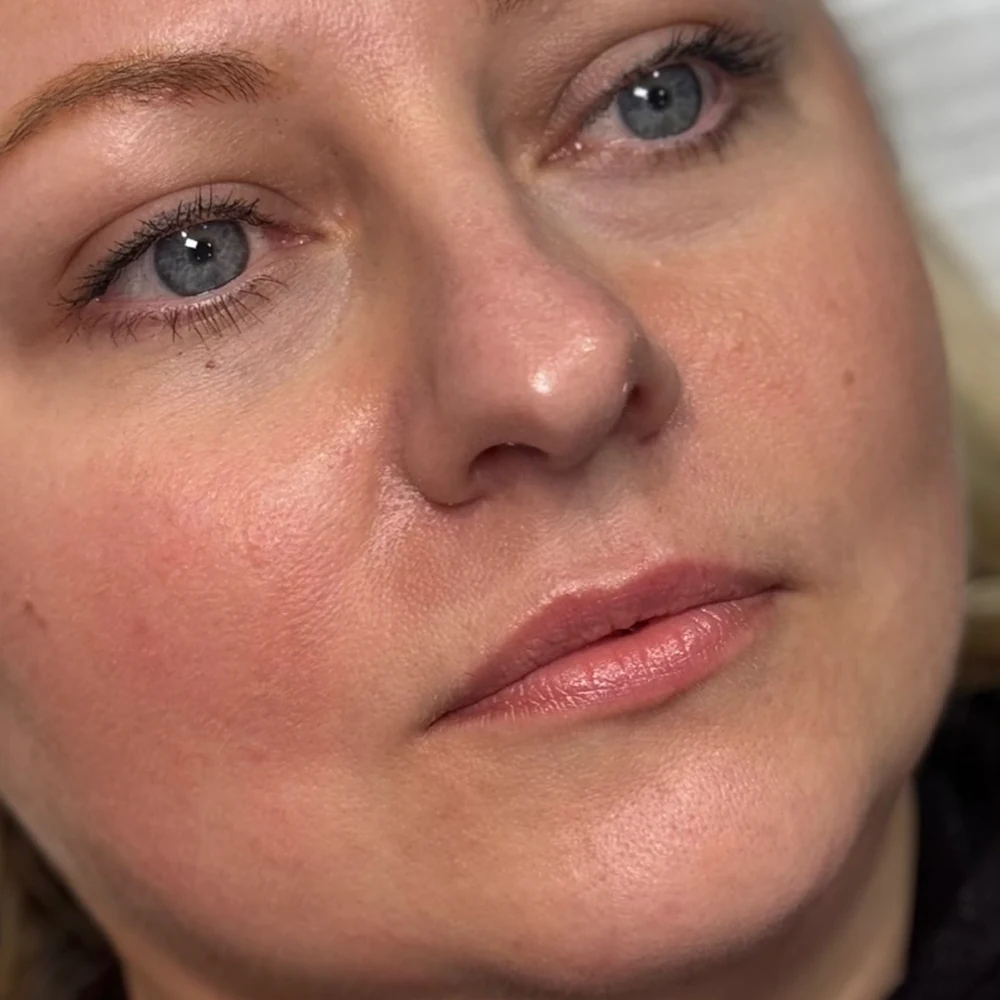 Before lip filler: lip volume and balance at Rejuvena Clinic, Bedford