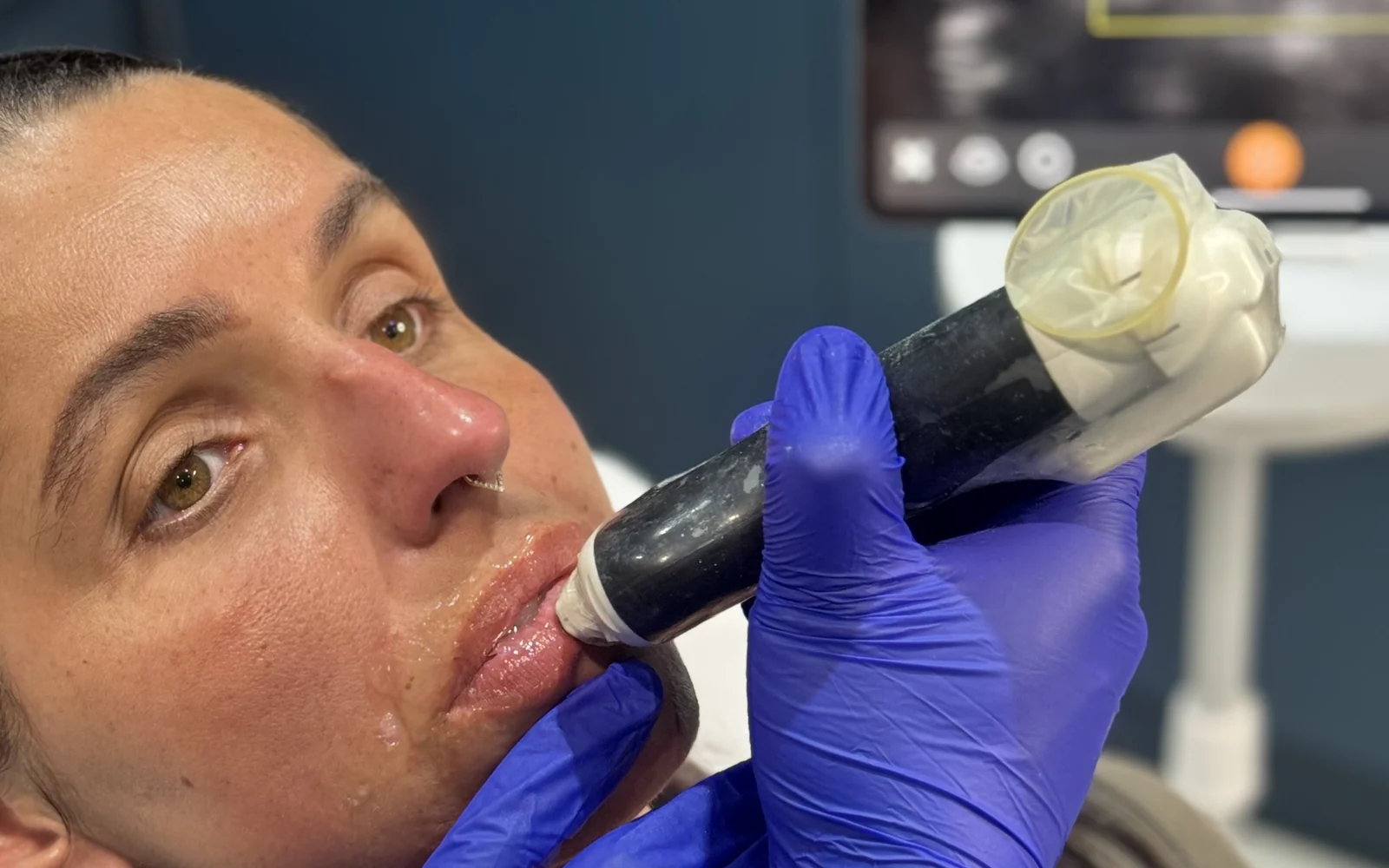 Dr Nick using high-frequency ultrasound imaging to guide a dermal filler injection, with the vascular scan visible on screen, at Rejuvena, Bedford