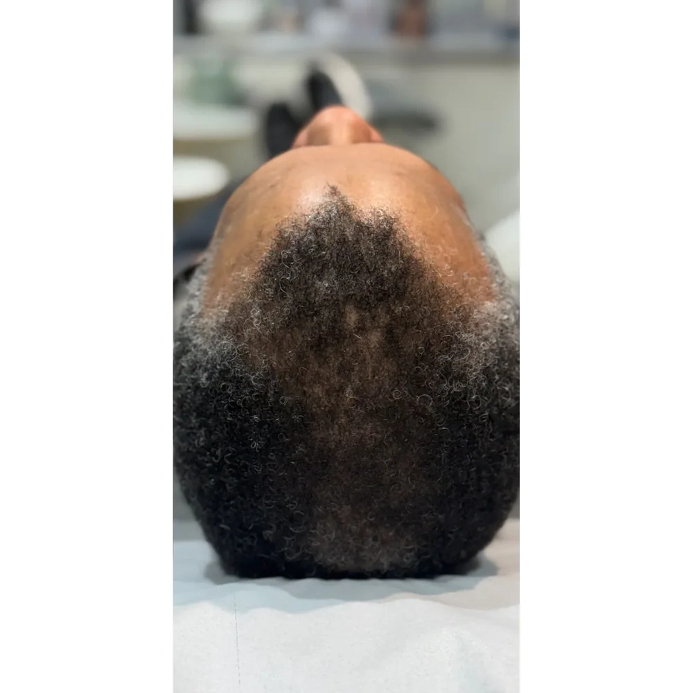 After a course of doctor-led PRP hair restoration at Rejuvena Bedford: improved crown density