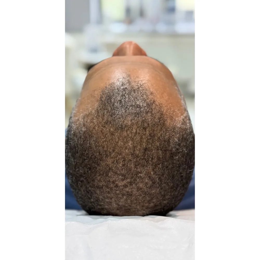Before treatment: crown thinning at Rejuvena Bedford