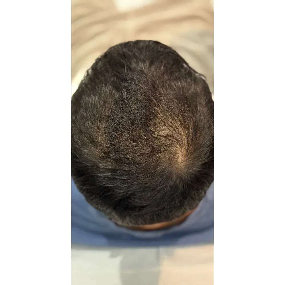 After a course of doctor-led PRP hair restoration at Rejuvena Bedford: improved crown density