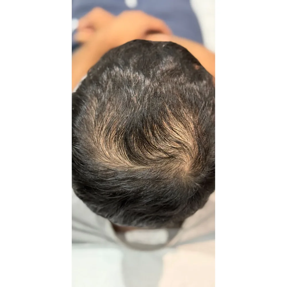 Before treatment: crown thinning at Rejuvena Bedford