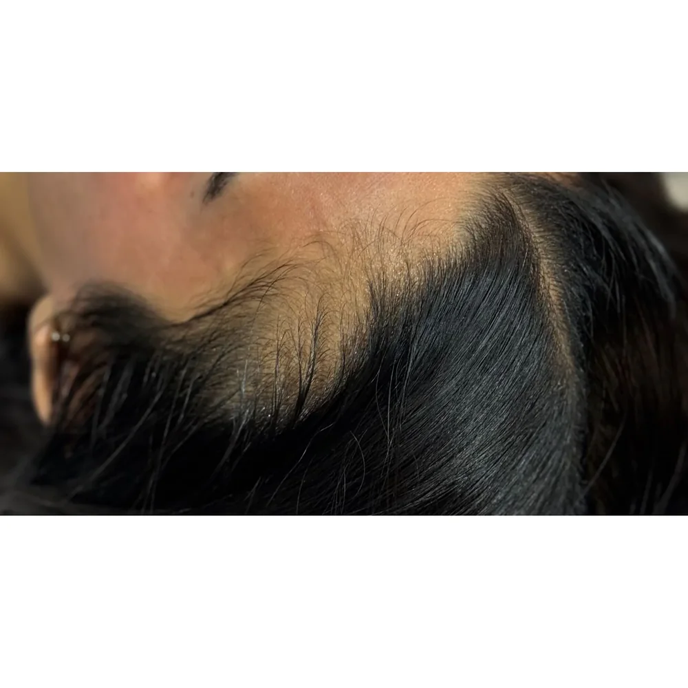 Before treatment: hairline and temple thinning at Rejuvena Bedford