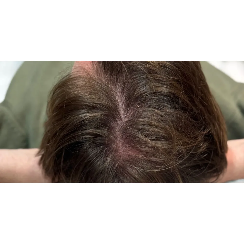 After a course of doctor-led PRP hair restoration at Rejuvena Bedford: improved mid-scalp density