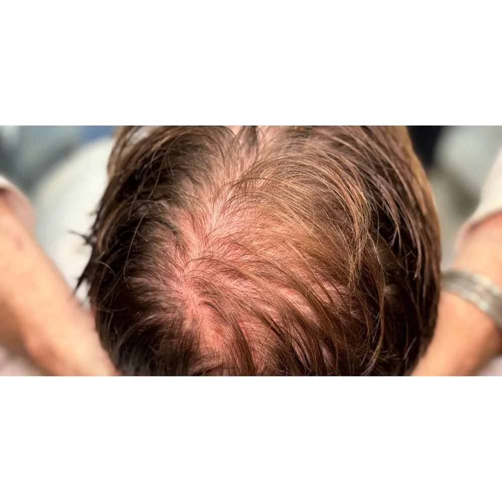 Before treatment: mid-scalp thinning at Rejuvena Bedford