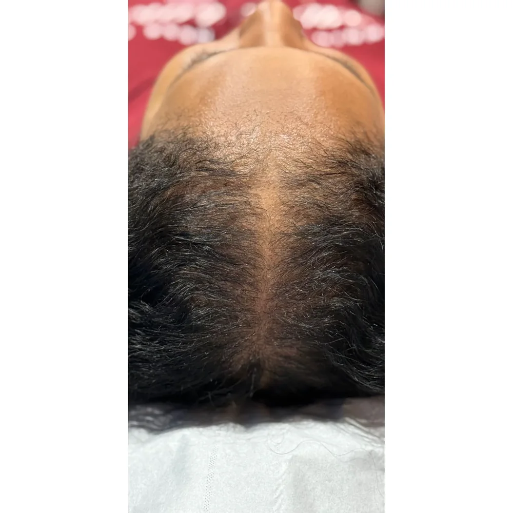 After a course of doctor-led PRP hair restoration at Rejuvena Bedford: improved crown density