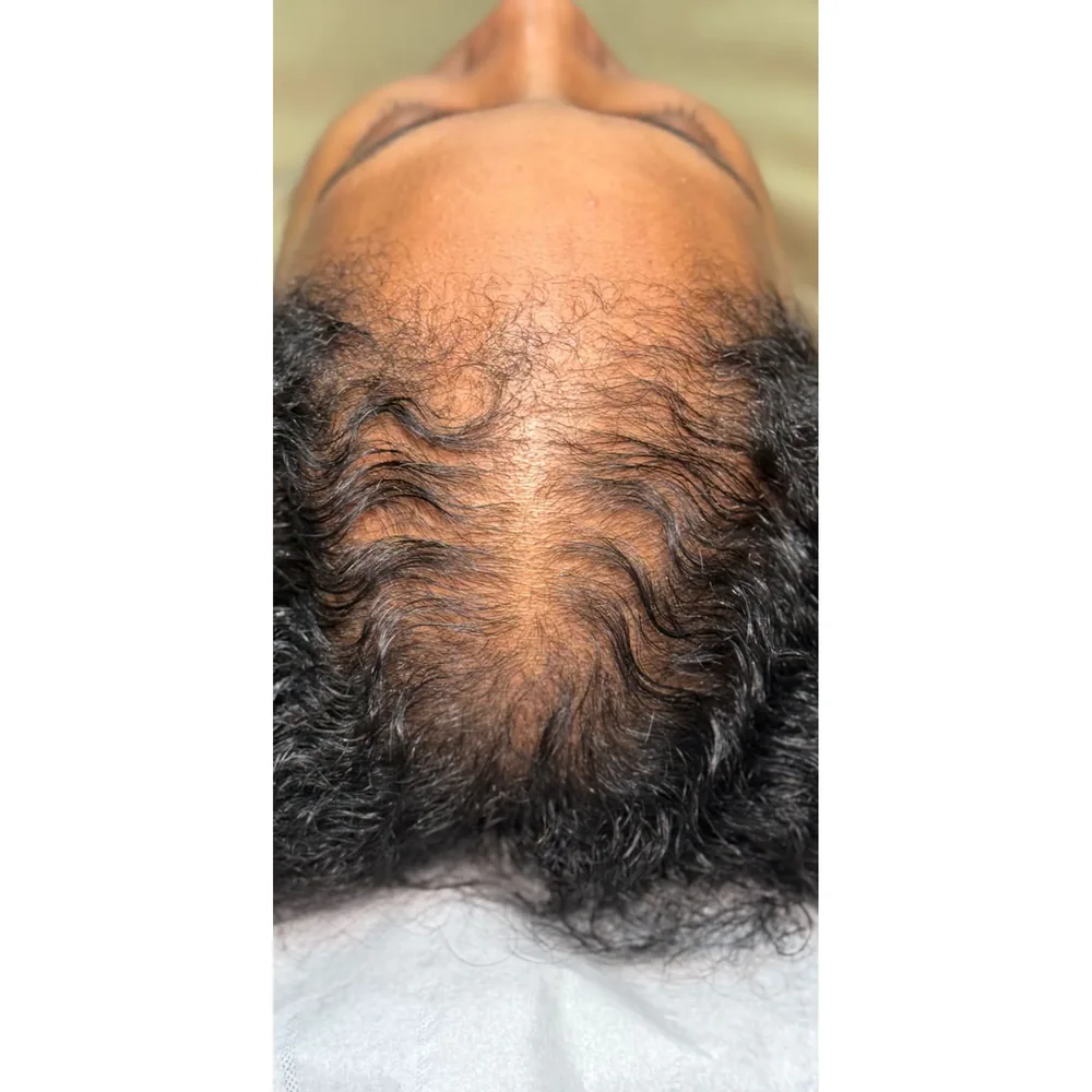 Before treatment: crown thinning at Rejuvena Bedford
