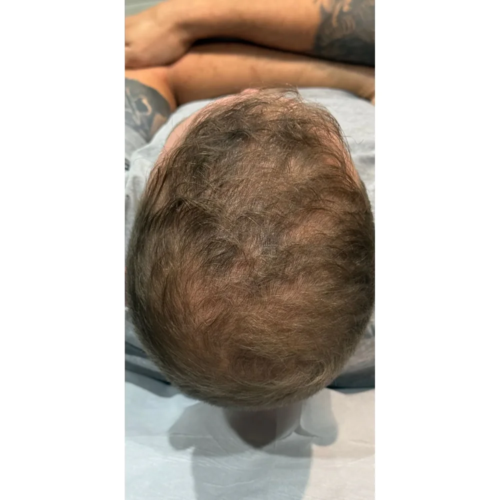 After a course of doctor-led PRP hair restoration at Rejuvena Bedford: improved overall density