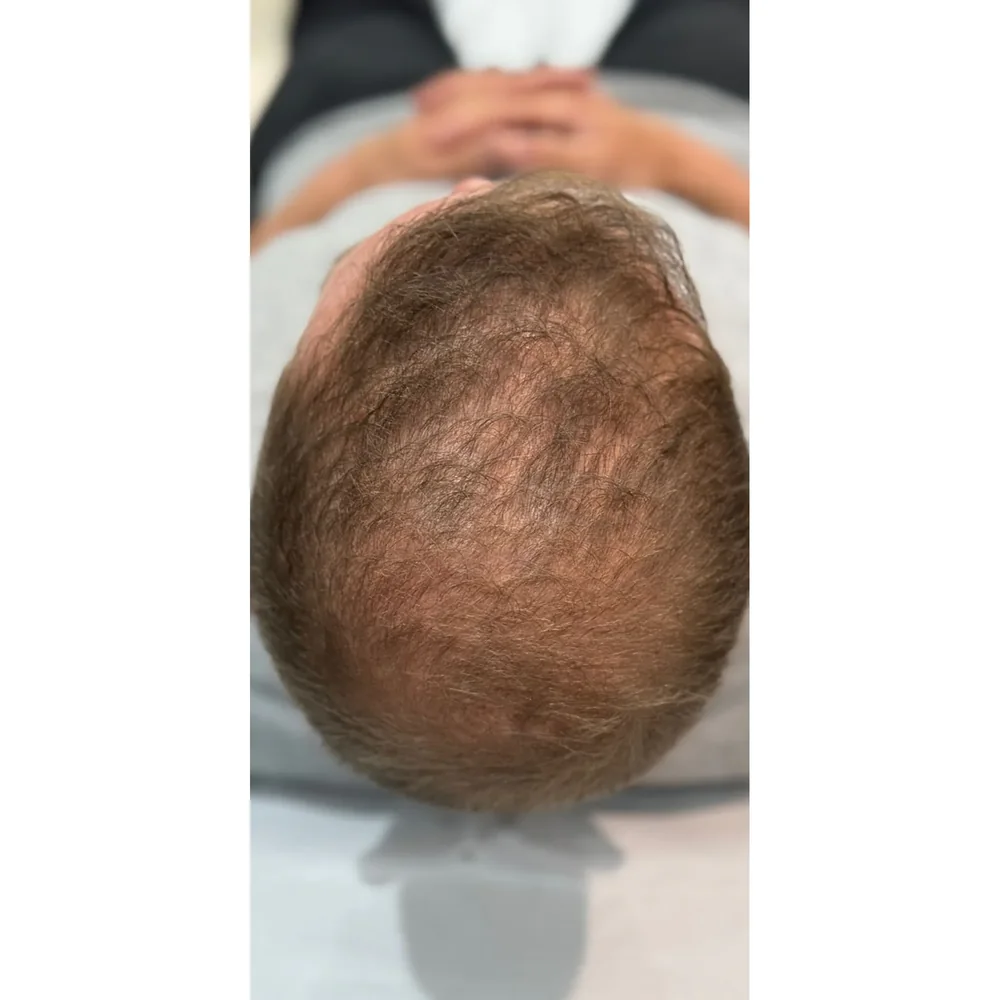 Before treatment: overall thinning at Rejuvena Bedford