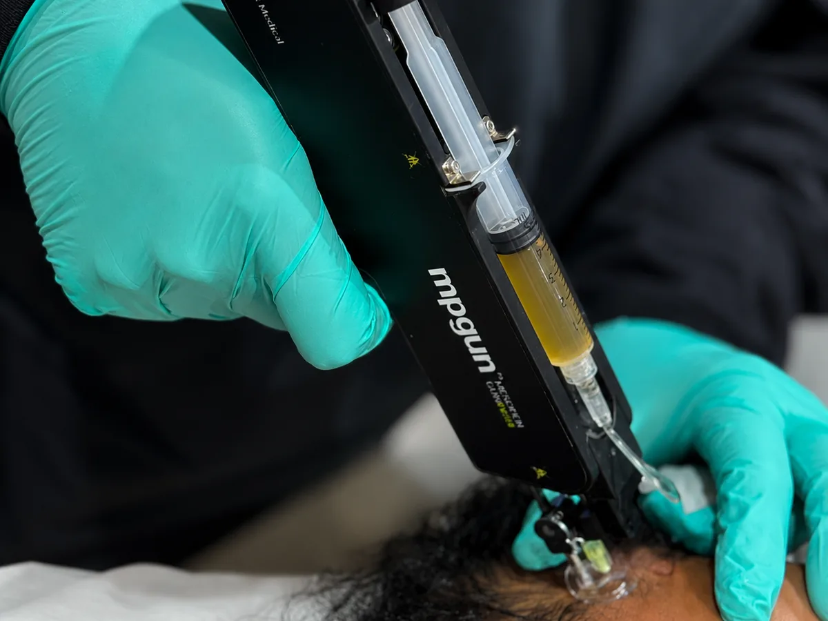 Close-up of the WorldPRP&reg; mpgun injector device loaded with PRP, positioned at a patient's scalp