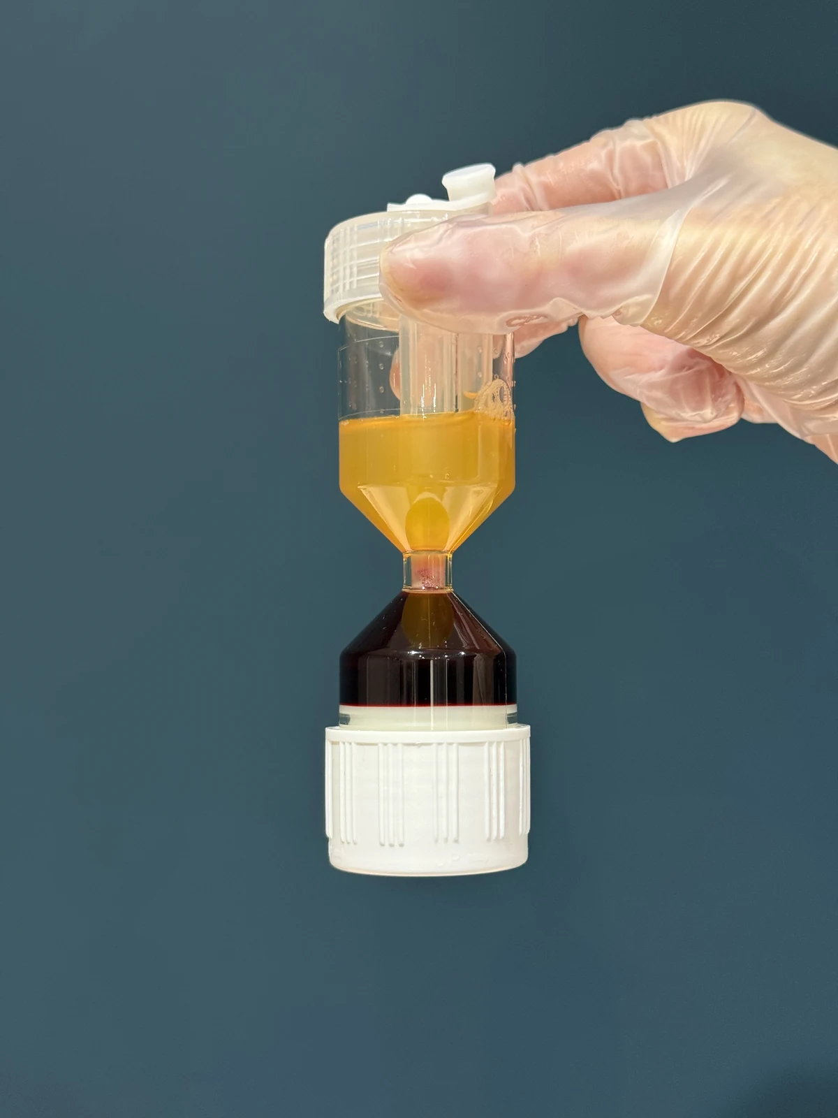 Gloved hands holding the WorldPRP&reg; hourglass tube after centrifugation, showing cleanly separated plasma and blood layers