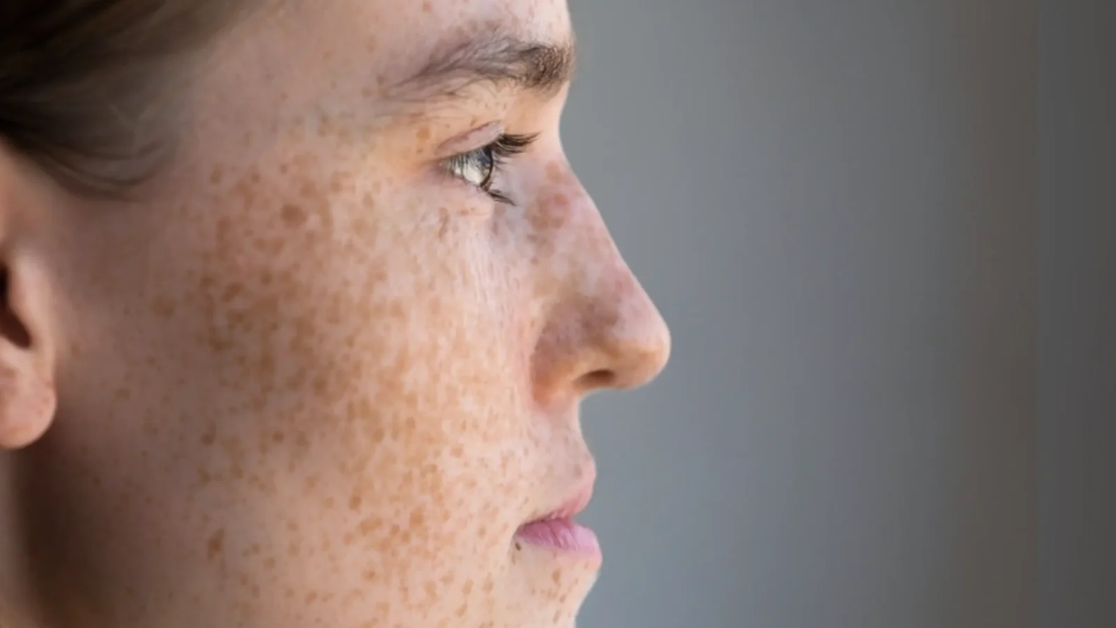 Natural side profile showing facial freckles