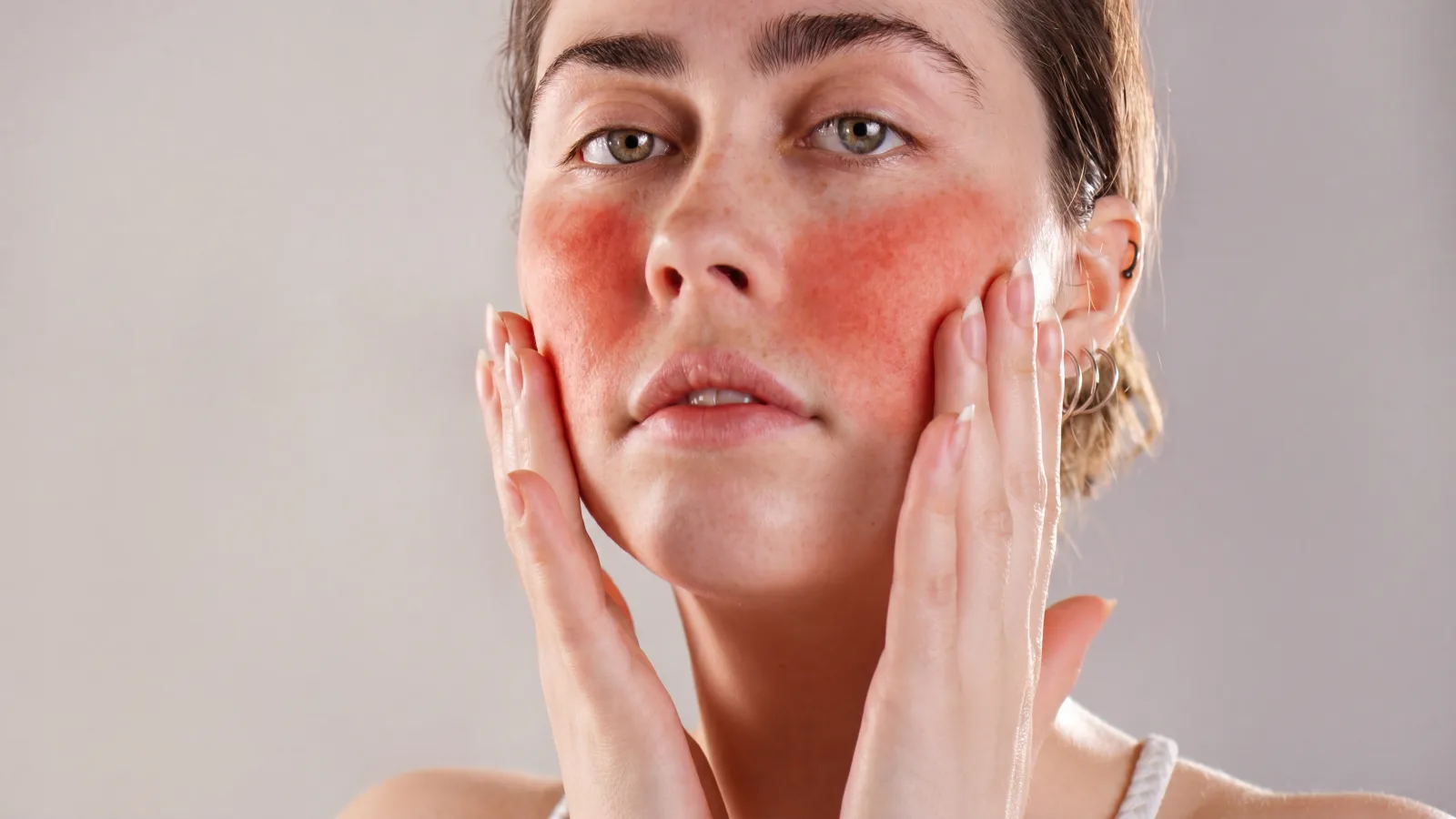 Doctor-led rosacea assessment at Rejuvena Clinic, Bedford