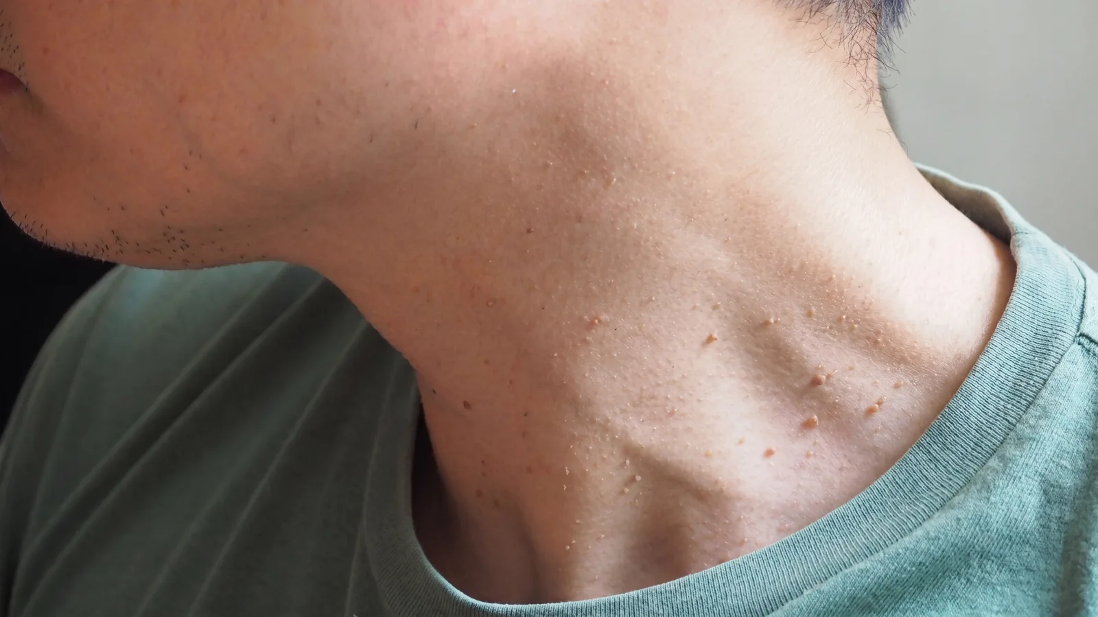 Close clinical view of a skin tag before removal