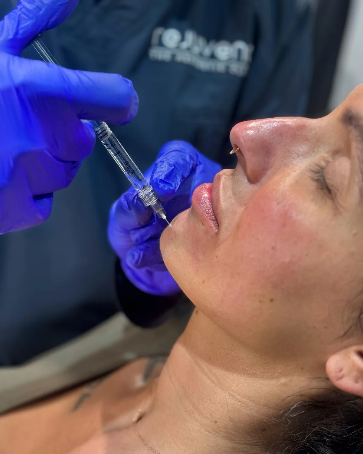 Dr Nick injecting hyaluronic acid dermal filler into a patient’s lips during a doctor-led treatment at Rejuvena Clinic, Bedford
