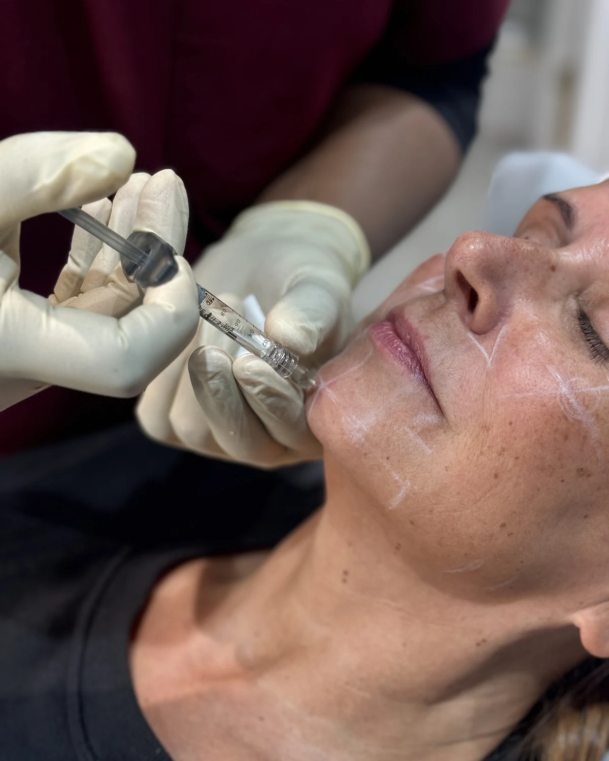 Doctor-led dermal filler treatment at Rejuvena, Bedford