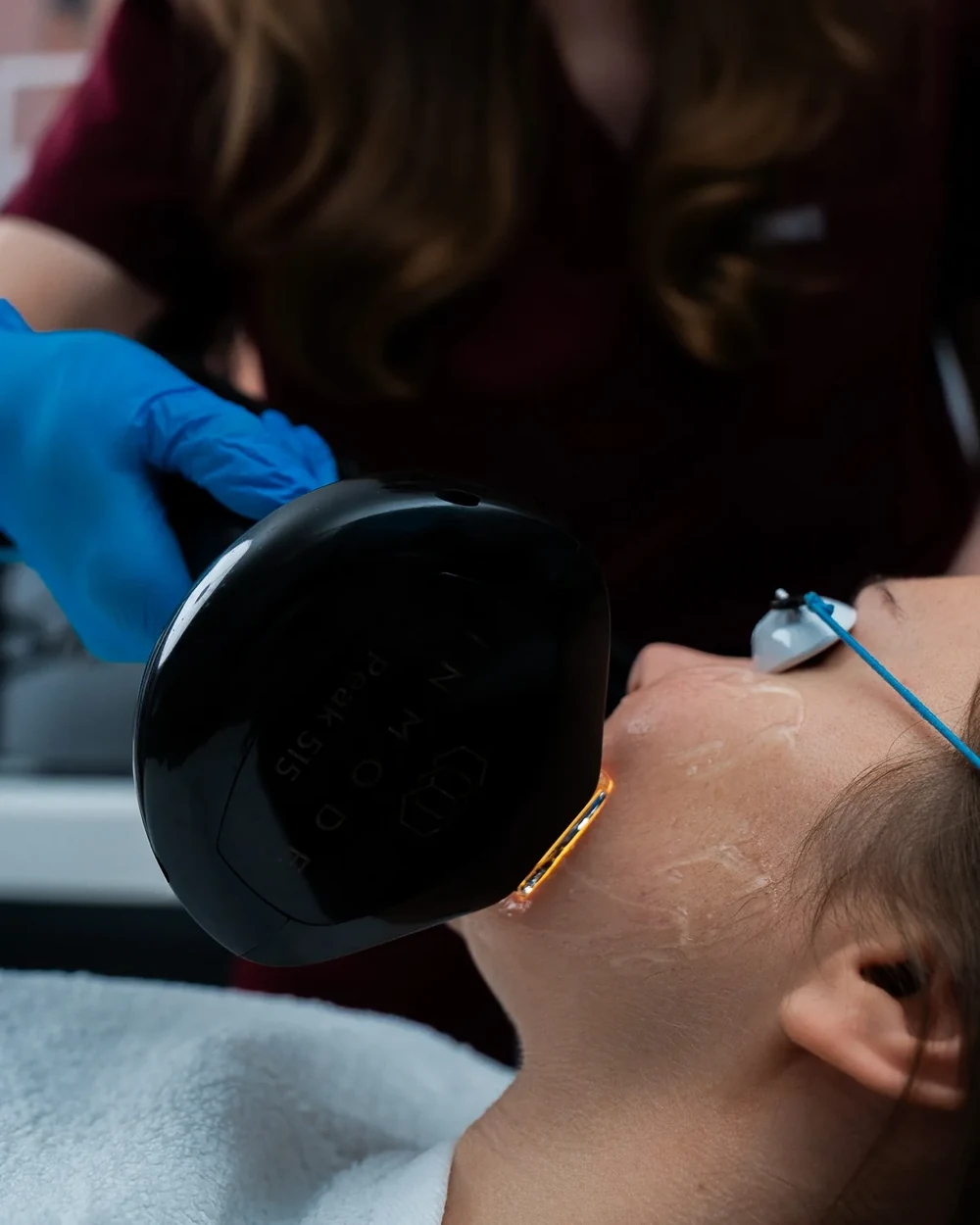 A clinician performing a Lumecca&trade; IPL treatment with the InMode handpiece on a patient’s cheek at Rejuvena Clinic, Bedford