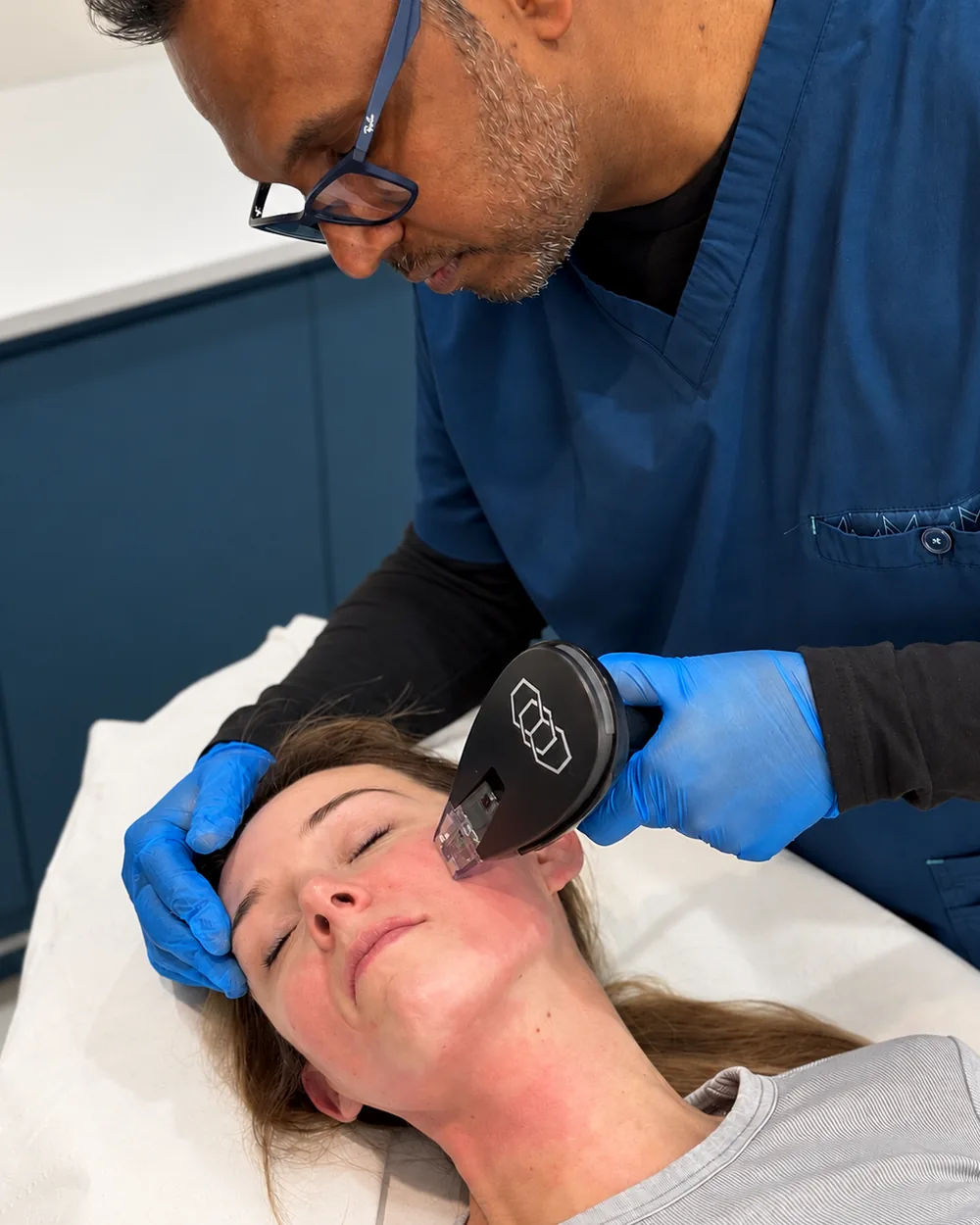Dr Nick performing Morpheus8 Burst RF microneedling on a patient’s cheek at Rejuvena Clinic, Bedford