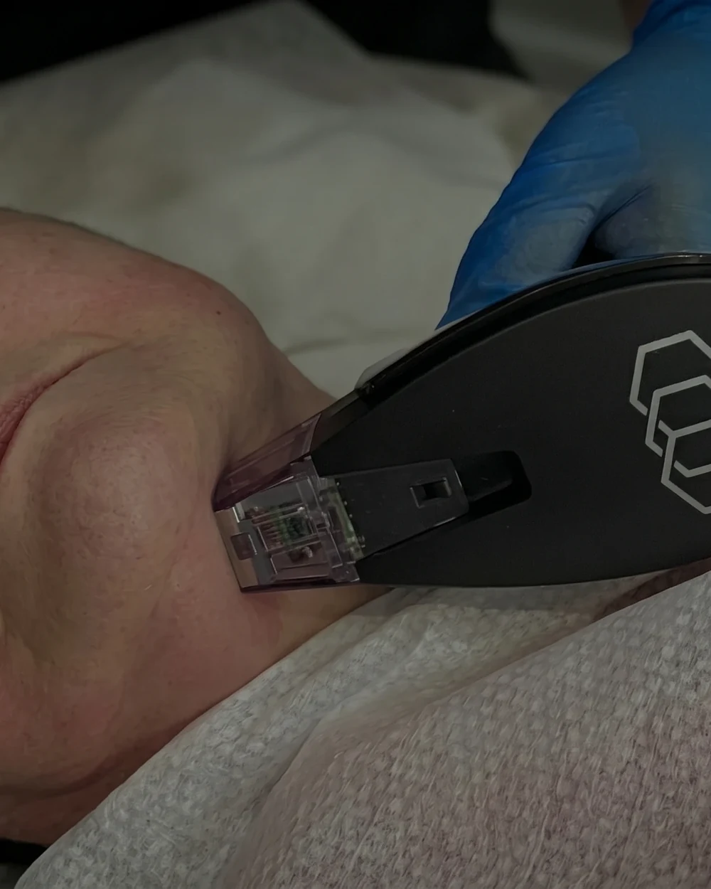 A clinician performing a doctor-led Morpheus8 Burst RF microneedling treatment along a patient’s jawline at Rejuvena Clinic, Bedford