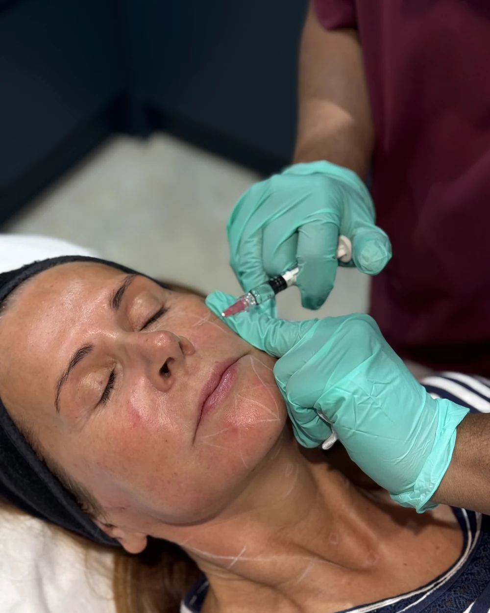 Dr Nick performing a Profhilo bio-remodelling injection, with bio-aesthetic points marked, at Rejuvena Clinic, Bedford
