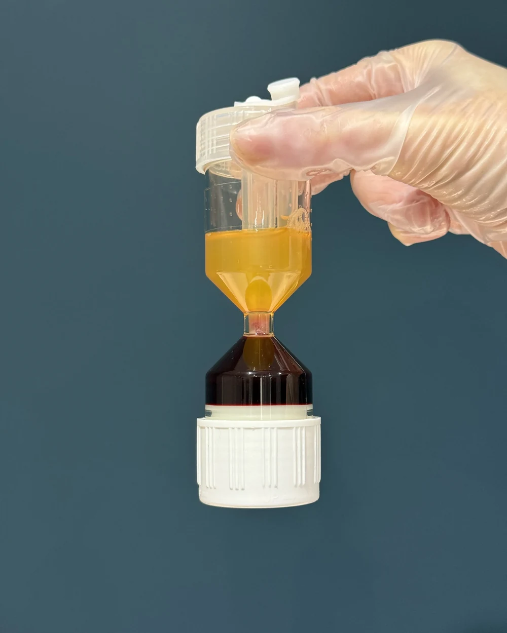 A gloved clinician holding a WorldPRP&trade; separator showing the golden platelet-rich plasma prepared for treatment at Rejuvena Clinic, Bedford