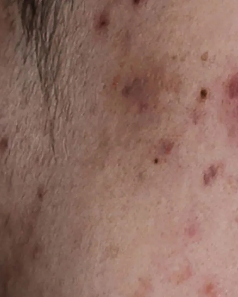 Rosacea treatment in Bedford