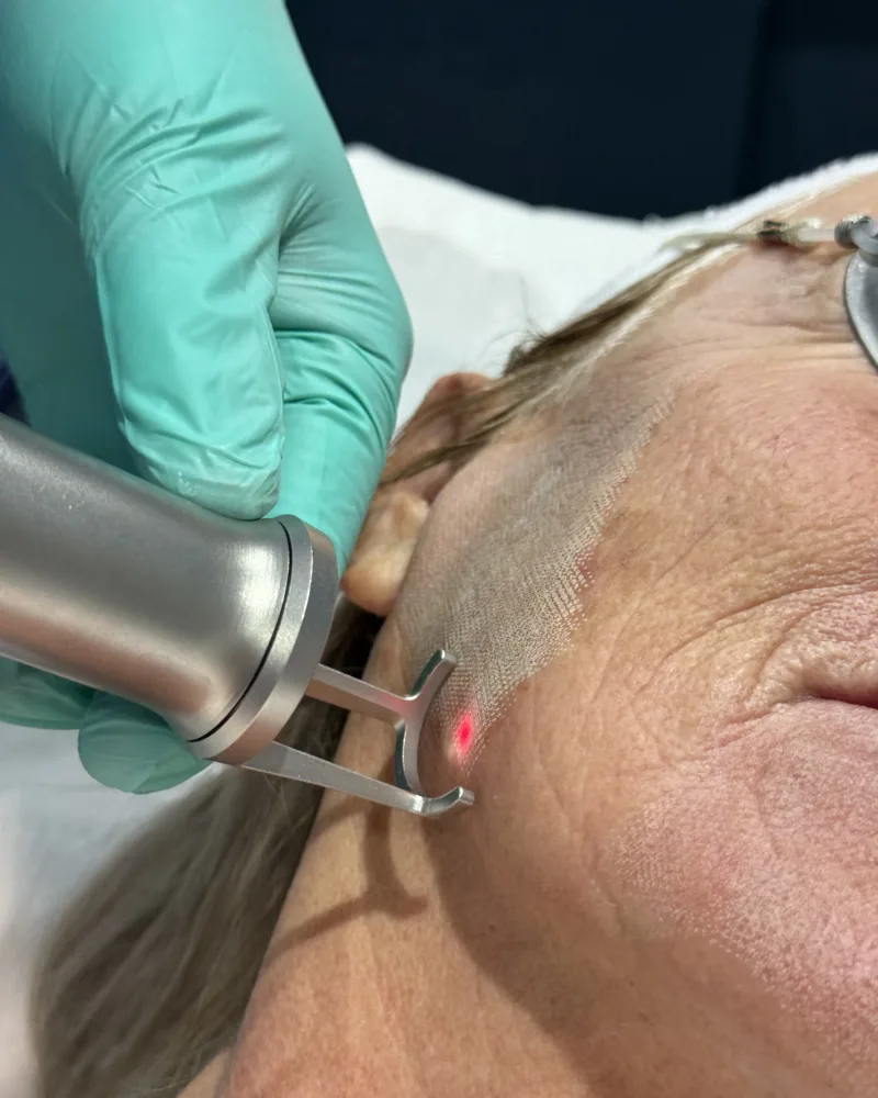 Cool Bleph non-surgical blepharoplasty in Bedford