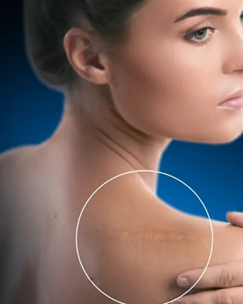 Cool Laser scar revision in Bedford
