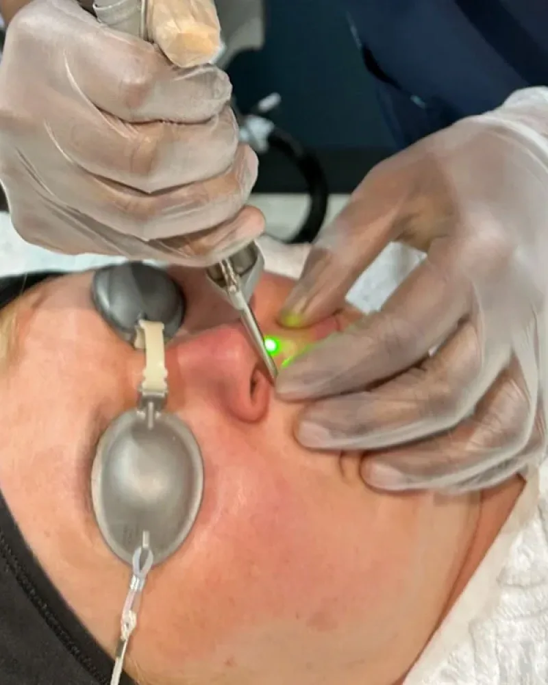 Laser skin lesion removal in Bedford