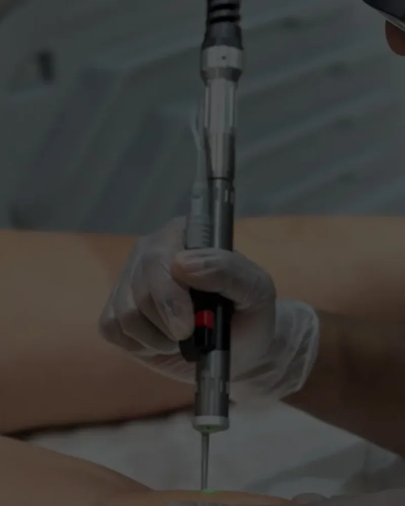 Thread vein removal in Bedford