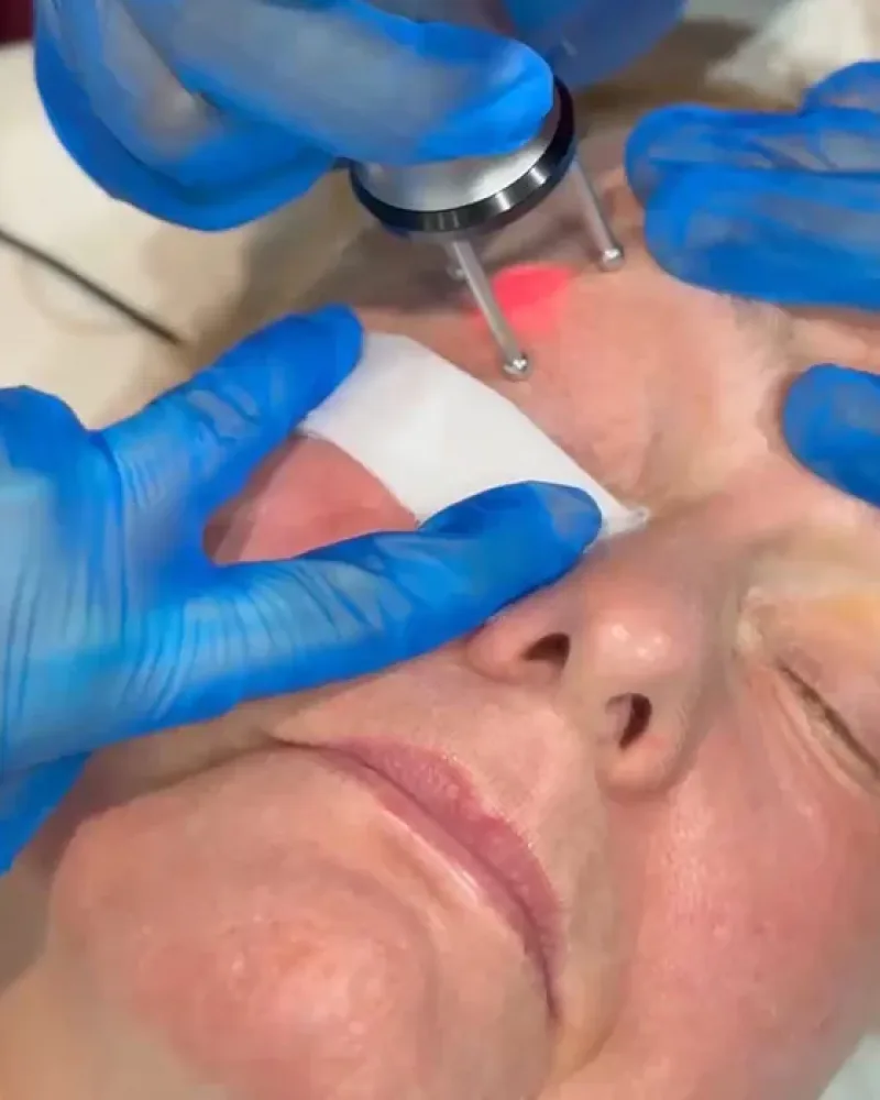 Cool Laser resurfacing in Bedford