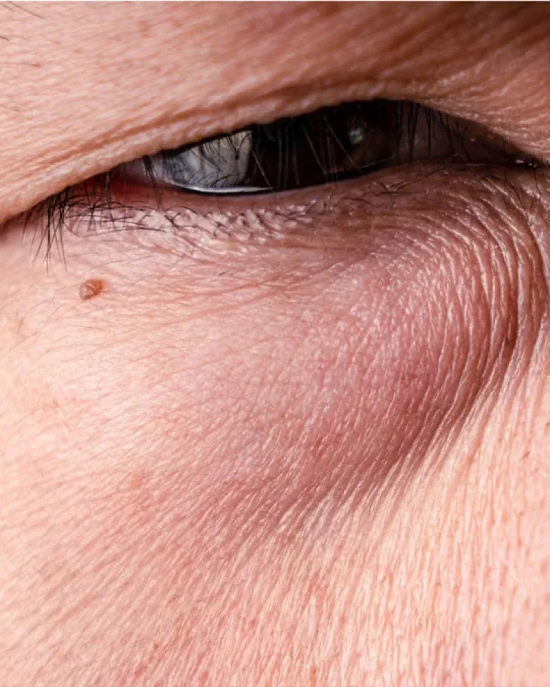 Doctor-led eye bag and tear trough assessment at Rejuvena Clinic, Bedford