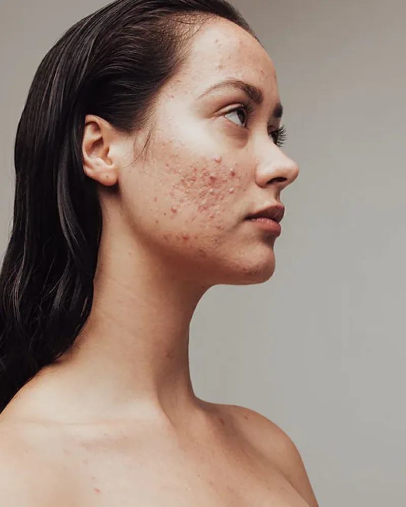 Acne treatment at Rejuvena Laser & Aesthetic Clinic in Bedford