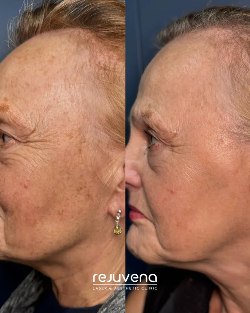Lumecca IPL in Bedford